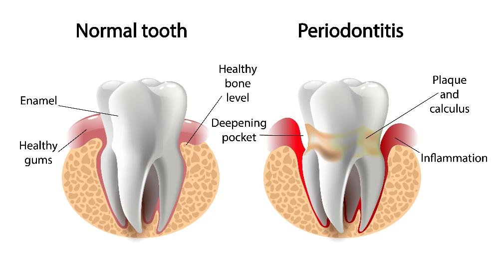 diagram of gum disease | dentist in los gatos