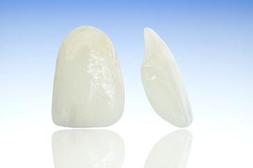 close up white veneers | veneers los gatos ca