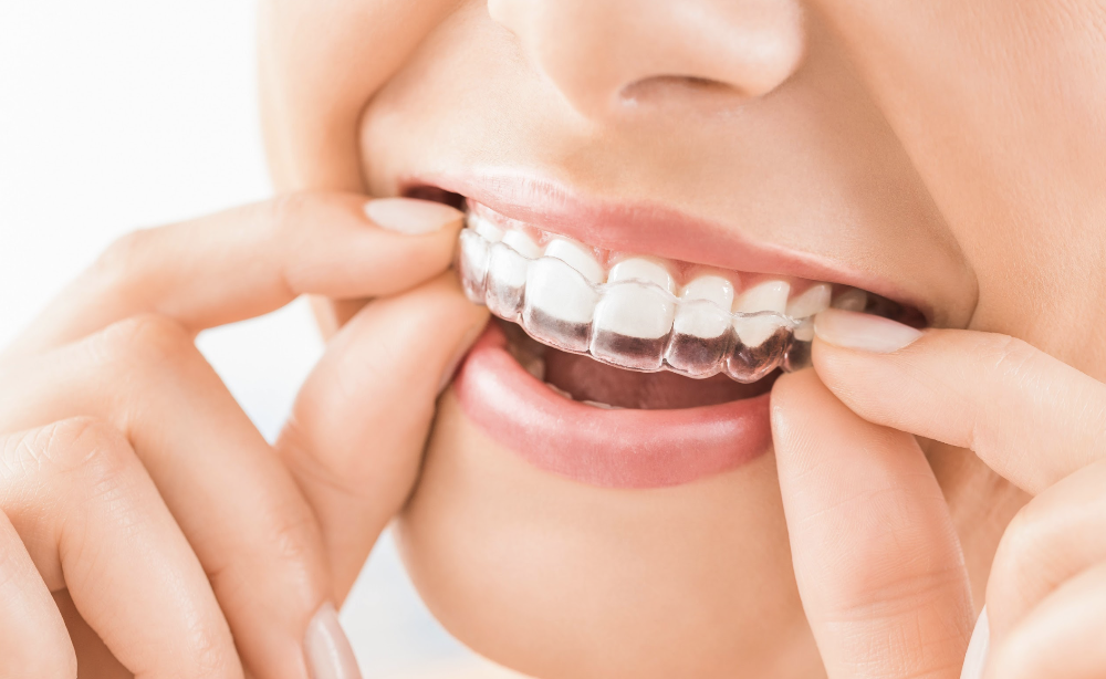 Woman putting clear aligners in her mouth, los gatos ca
