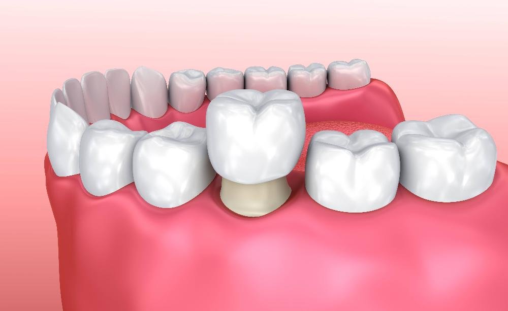 close up dental crown in jaw | dental crowns los gatos ca