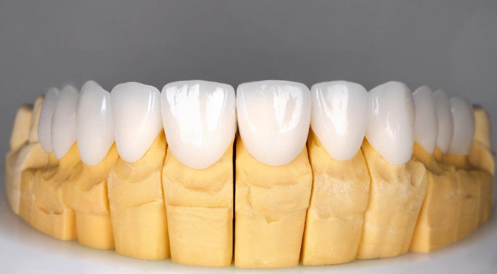 porcelain veneers on teeth | veneers los gatos