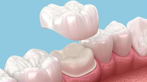 dental crown on tooth | dental crowns los gatos ca