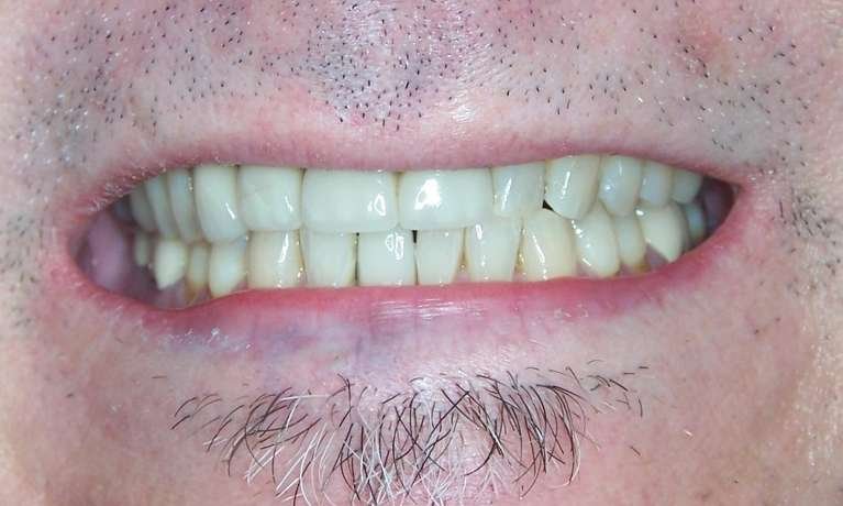 complete smile after cosmetic dentistry | los gatos cosmetic dentist