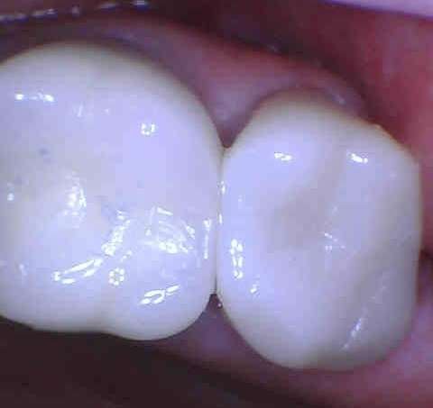 new custom ceramic crown | dental crowns los gatos ca