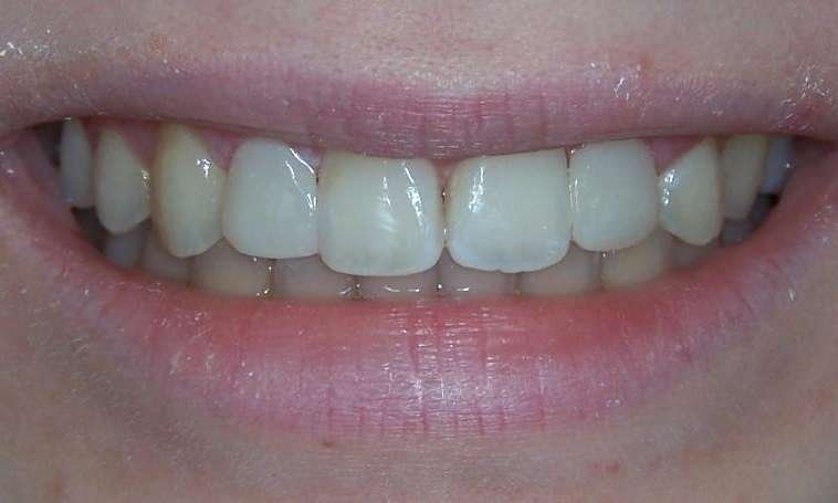 complete smile after dental treatment | dentist los gatos ca