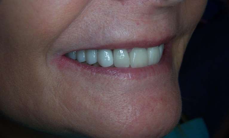 after picture of dental bridge installation in los gatos ca