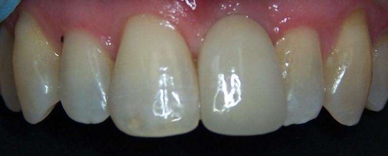 complete smile after dental crown | dental crown los gatos ca