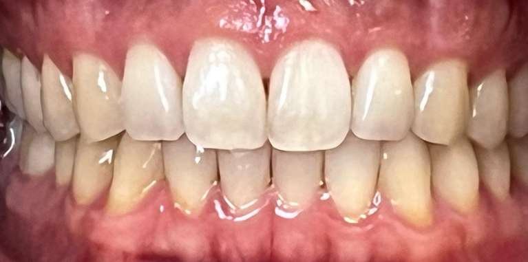 bright smile after teeth whitening | los gatos ca dentist