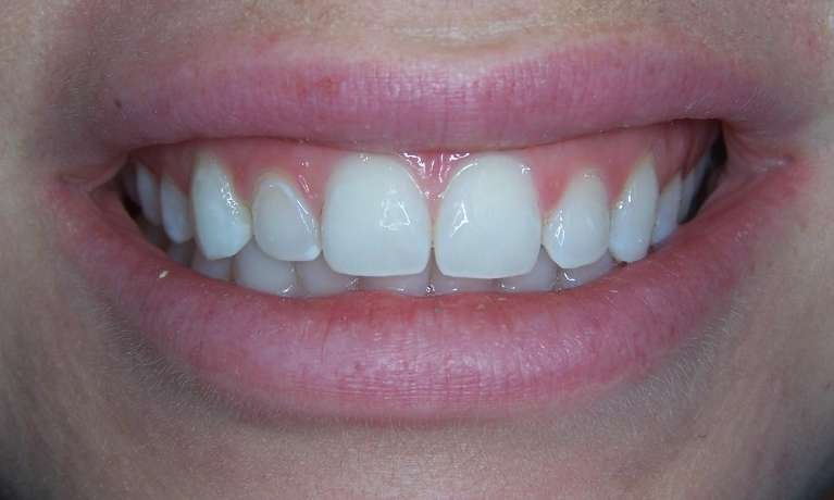 after picture of white spot treatment, los gatos ca