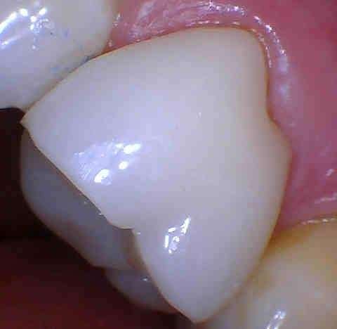 side of tooth after dental crown