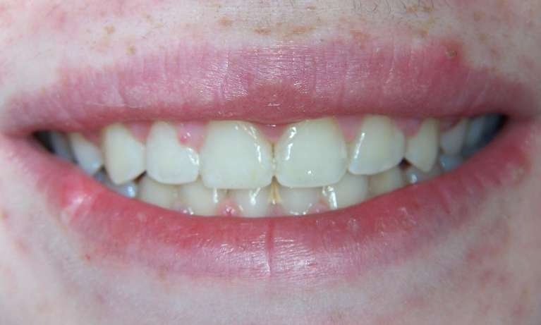 after dental treatment complete smile | los gatos ca dentist