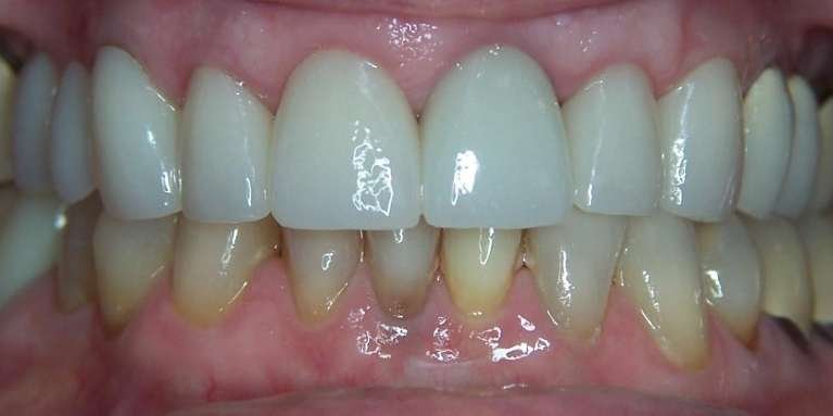 dental crowns before & after | dentist los gatos ca
