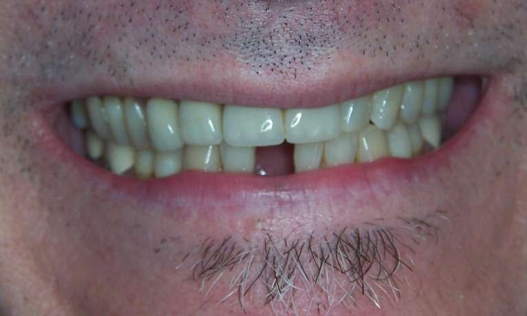 missing tooth before dental services | dentist in los gatos ca