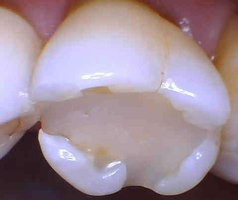 cracked tooth before dental crown | los gatos dentist