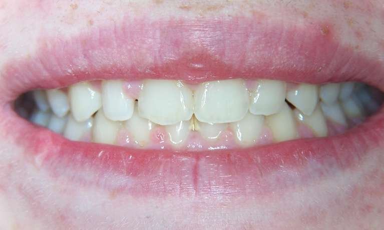 chipped and smaller teeth before | cosmetic dentistry los gatos ca