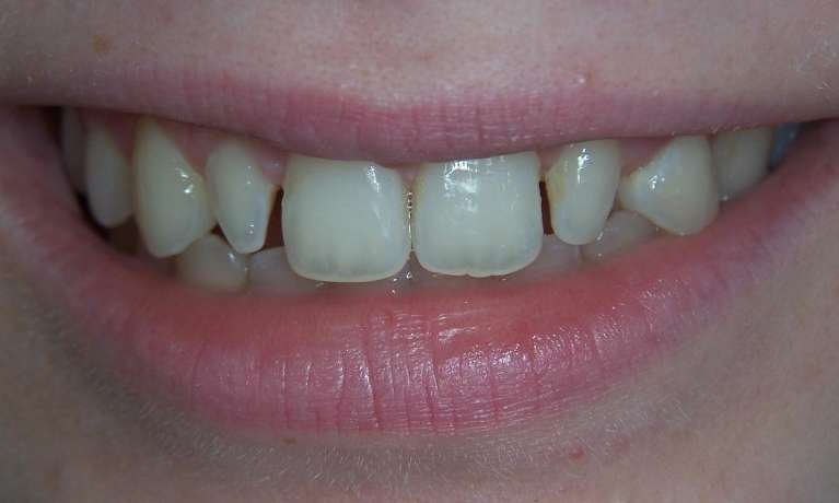 small teeth before cosmetic dentistry | dental bonding los gatos ca