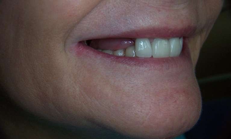 before picture of dental bridge installation in los gatos ca