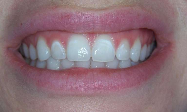 before picture of white spot treatment, los gatos ca