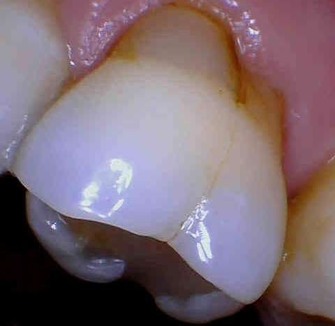 side view of cracked tooth before dental crown